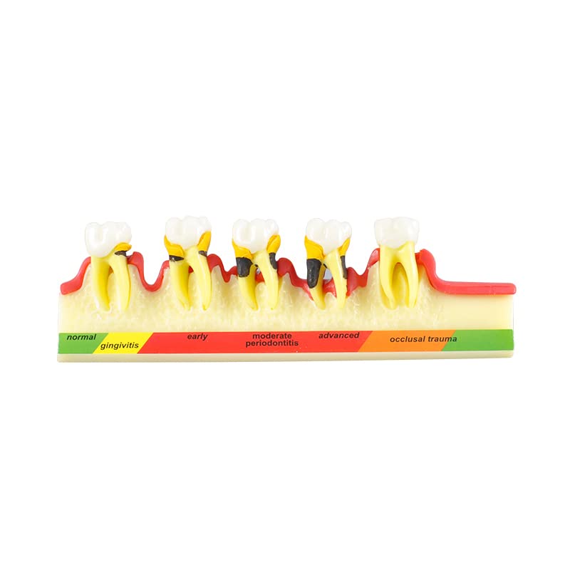 מודל סיווג שיניים של MRHUGOO מודל סיווג חניכיים מודל מחלת חניכי