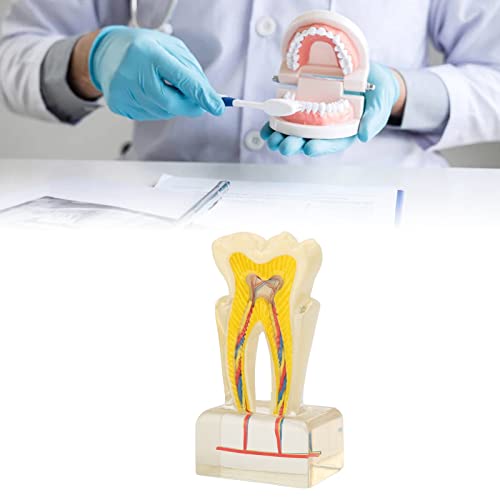 שיניים עששת דגם, אקריליק 6 פעמים רקובים שן דגם שיניים חינוך אספקת שיניים דגם עששת שיניים דגם עבור רופאי שיניים